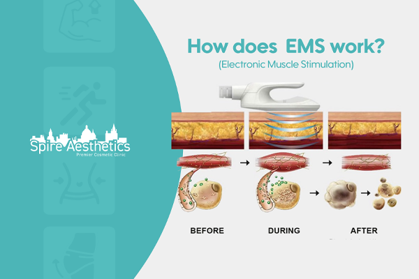EMS treatment for post pregnancy weight loss treatment Airdrie
