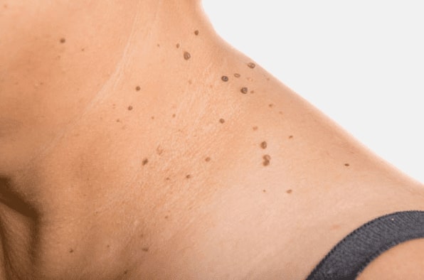 Are you looking for easy skin tag removal Airdrie - then contact Spire today!