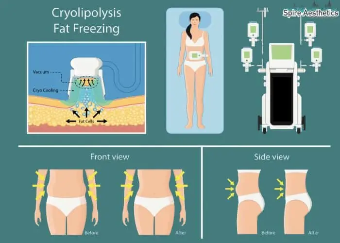 Fat freezing treatment Airdrie benefits for competitions to remove stubborn fat deposits.