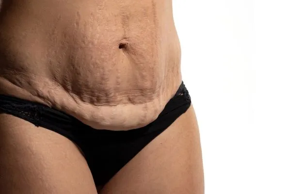 Image of womans stomach after weight loss injections Airdrie showing saggy skin
